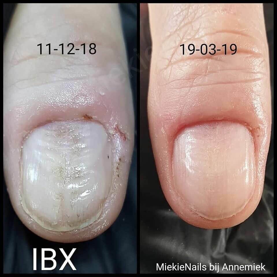 IBX до и после
