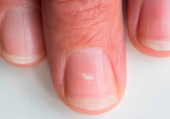Периодически на ногтях могут появляться белые пятна