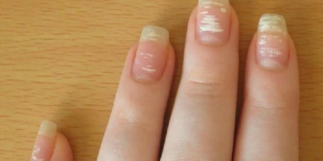 Посмотрите на свои ногти. Эти 12 отклонений могут многое рассказать о вашем здоровье