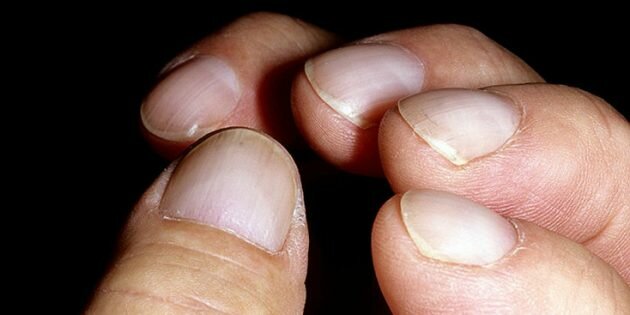 Посмотрите на свои ногти. Эти 12 отклонений могут многое рассказать о вашем здоровье